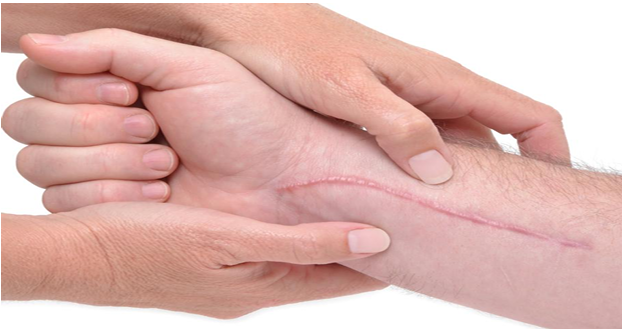 Traitement des cicatrices à Crozon