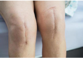 Prise en charge des cicatrices