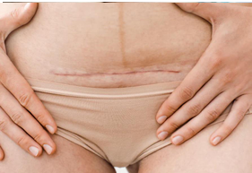 Traitement ostéopathique des cicatrices