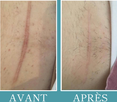 Mobilité tissulaire et cicatrices